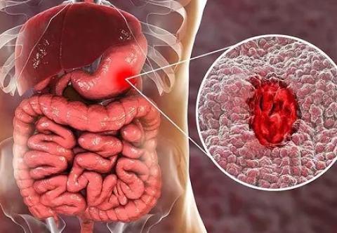 Ung thư dạ dày có nguy hiểm không?